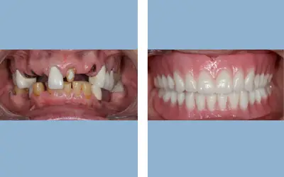 Before and After